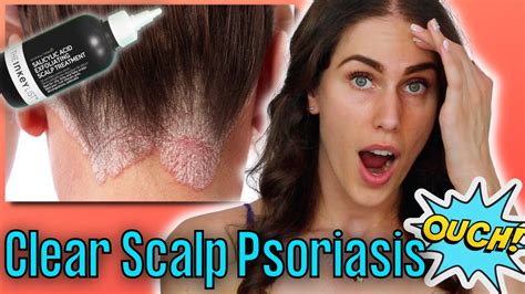 Why My Hair Is Falling Out And Scalp Is Bleeding Psoriasis And Scalp
