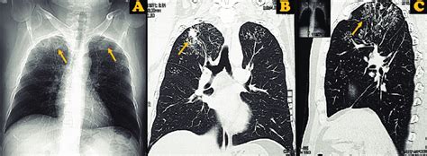 A Chest X Ray Showed Reticular And Interstitialopacities In Both