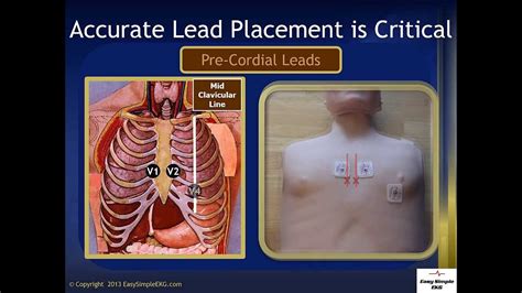 Ekg Lead Placement Youtube