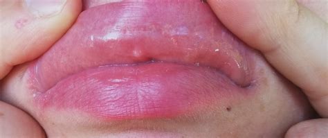 Pickel sollte man am besten in ruhe lassen. Lippe pickel die brennen was ist das? (Blasen)