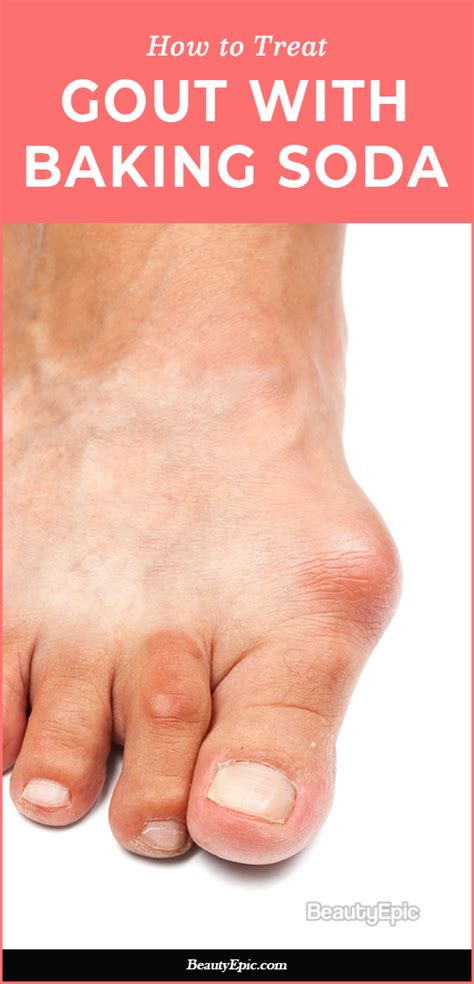 Baking Soda For Gout Does It Work