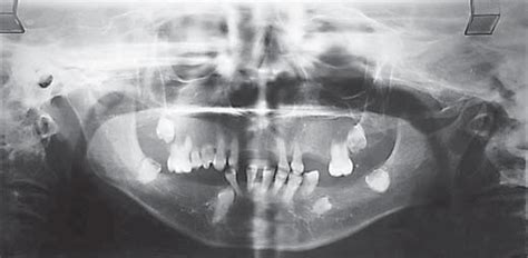 Panoramic Radiograph Showing Generalized Rarefaction Of The Jaw Bone
