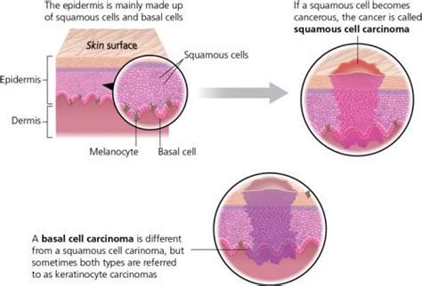 What Is Advanced Cutaneous Squamous Cell Carcinoma The Waiting Room