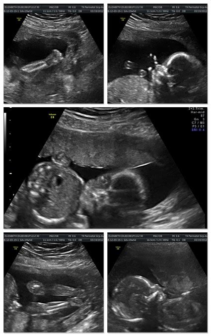 By 18 to 20 weeks, the placenta weighs about 5 ounces. Just Another Day in Wileydise: 20 weeks - Them Edition