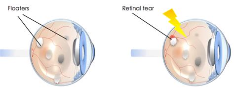 Retina Vitreous Consultants Hacdoodle