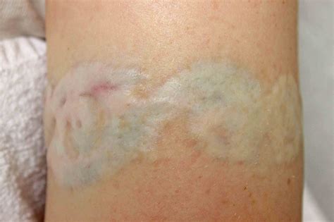 Maybe you would like to learn more about one of these? Scar Tattoos Designs, Ideas and Meaning | Tattoos For You