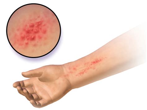 I've gotten it to where i can even see it a little above. What to Do When Your Ring Irritates Your Skin : Causes and ...