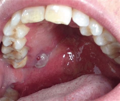 Kaposi Sarcoma Oral Cavity
