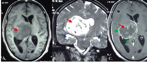 Cureus Subtotal Resection Of A Thalamic Glioblastoma Multiforme