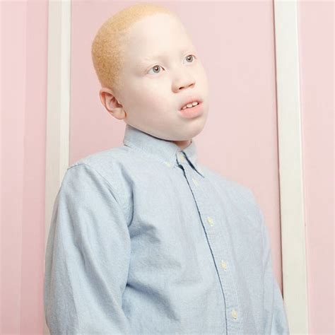 Unique Portraits Of People With Albinism Clrn Org