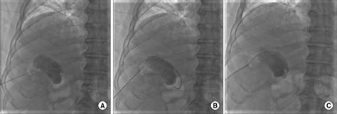 Intra Abdominal Percutaneous Drainage A A Needle Is Getting Into The