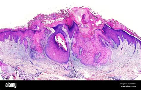 Light Microscopy Of Squamous Cell Carcinoma Of Skin A Skin Cancer