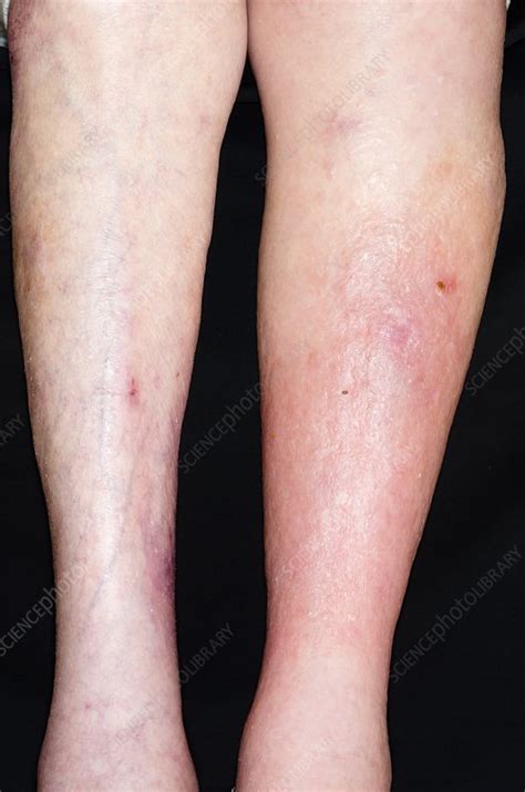 Deep Vein Thrombosis In The Leg Stock Image C0155998 Science