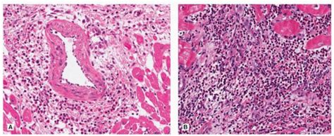 Hypersensitivity Eosinophilic And Toxic Myocarditis Thoracic Key