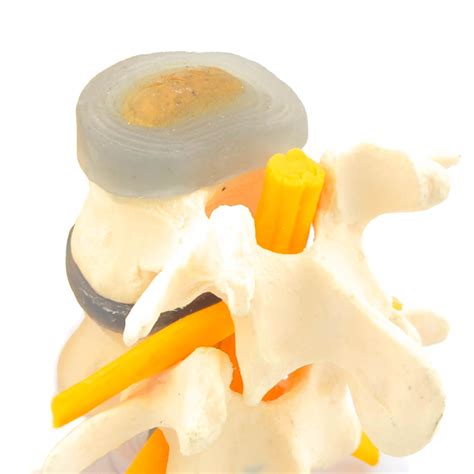 Eine ausnahme stellt dabei die gelenkige verbindung zwischen. HeineScientific | Bandscheiben-Modell