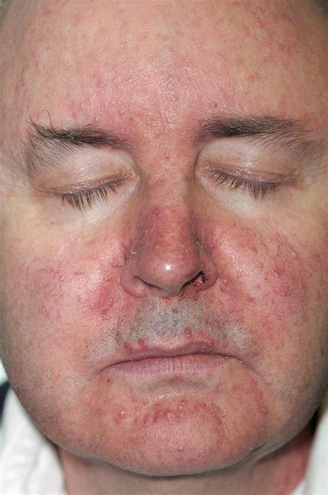 Skin Rash Following Chemotherapy Photograph By Dr P Marazziscience