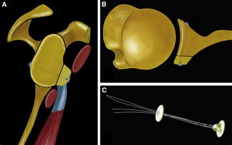 Arthroscopic Latarjet Procedure With Cortical Button Fixation A The