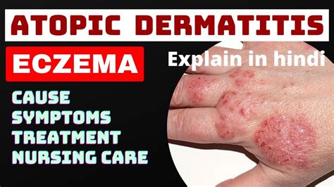 Eczema Atopic Dermatitis In Hindi Cause Symptoms Treatment