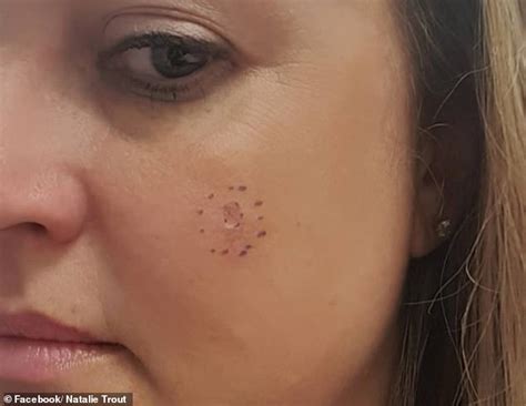 Show Pictures Of Skin Cancer On The Face Cancerwalls