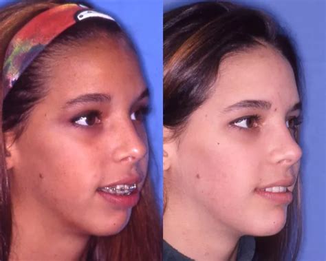 Jaw Surgery Gallery Alpharetta Before And After Jaw Surgery Photos