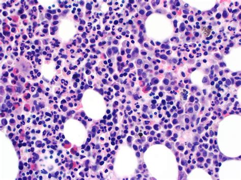Paraneoplastic Leukemoid Reactions Induced By Cytokine Secreting