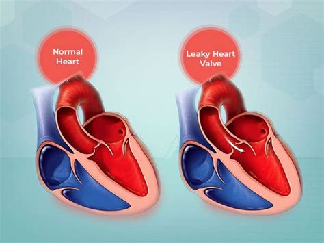 What Is Leaky Heart Valve Its Symptoms Causes And Treatment Images