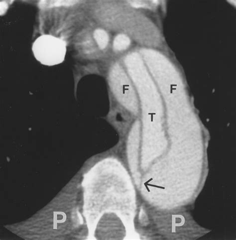 Aortic Dissection Ct Features That Distinguish True Lumen From False Lumen Ajr