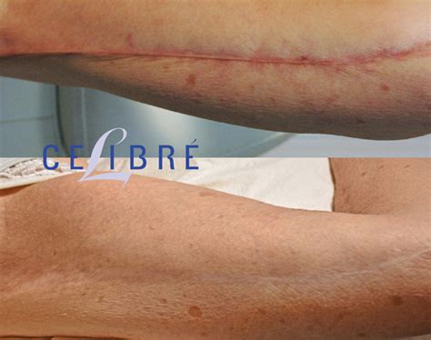 Scar Removal Before And After Pictures