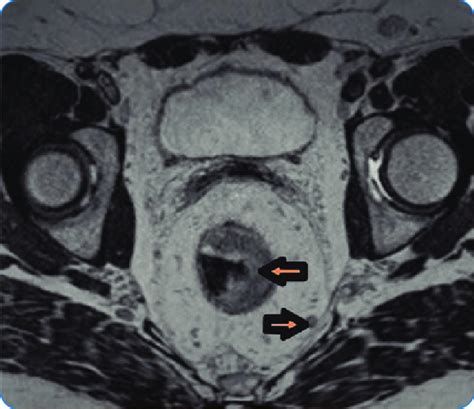 Pelvic Mri Revealed A Locally Advanced Rectal Cancer With Multiple