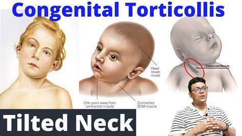 Tilted Neck Congenital Torticollis Congenital Disorder Youtube