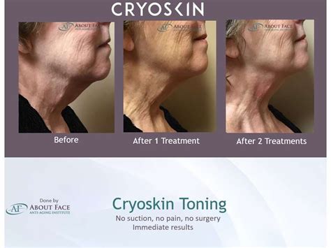 Cryoskin Toning Before And After Harker Heights Killeen Tx 1 Med Spa