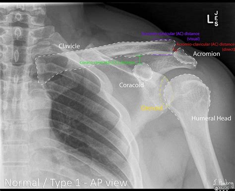 Shoulder Ligament Tears And Clavicle Dislocation Ph