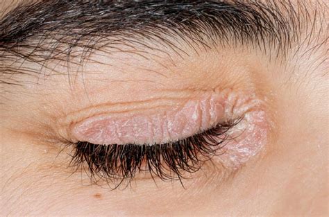 Emuaid reduces itching, pain and inflammation at least 50% within 24 hours use. Everything Dry Eyelids - Richmond Hill Cosmetic Clinic