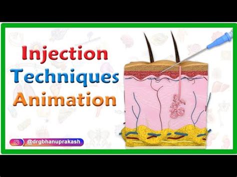 Injection Techniques Animation Intradermal Intramuscular