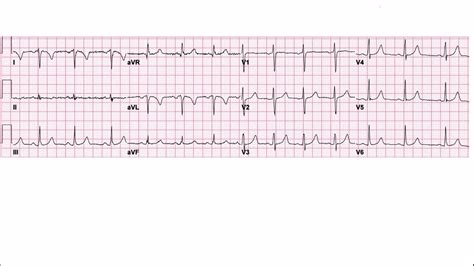 Lead Reversal And Dextrocardia Ecg Explanation Youtube