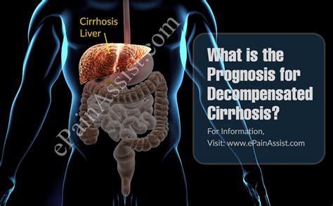 Chronic liver disease and cirrhosis result in about 35,000 deaths each year in the united states. What is the Prognosis for Decompensated Cirrhosis?