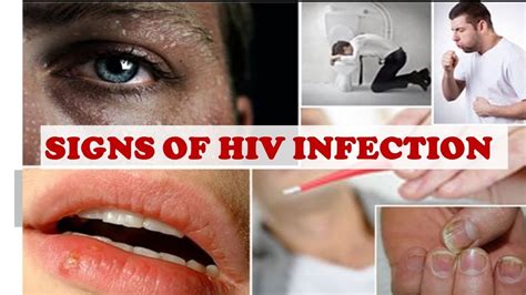 5 Common Hiv Symptoms In Men Ladies See How To Know If He’s Hiv Positive Check No 3