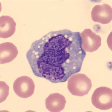 Figure 11 — All These Cells Are Monocytes Showing The Variation In