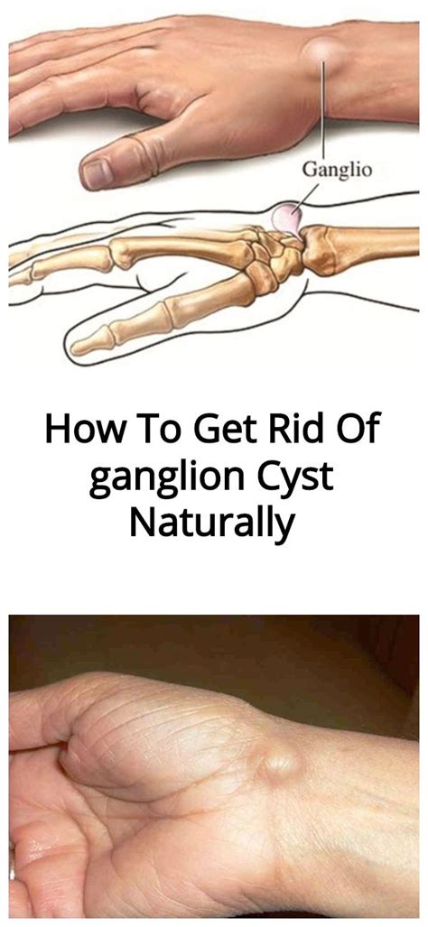 How To Get Rid Of A Foot Ganglion Cyst Margaret Greene Kapsels