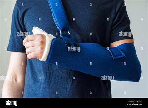 Plaster Cast On Arm Hi Res Stock Photography And Images Alamy