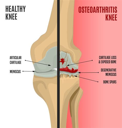 Osteoarthritis Knee Pain Get Relief From Gae Precision Vascular