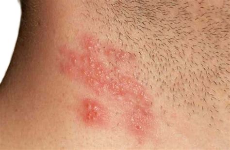 Shingles Herpes Zoster Varicellazoster Virus Skin Ras