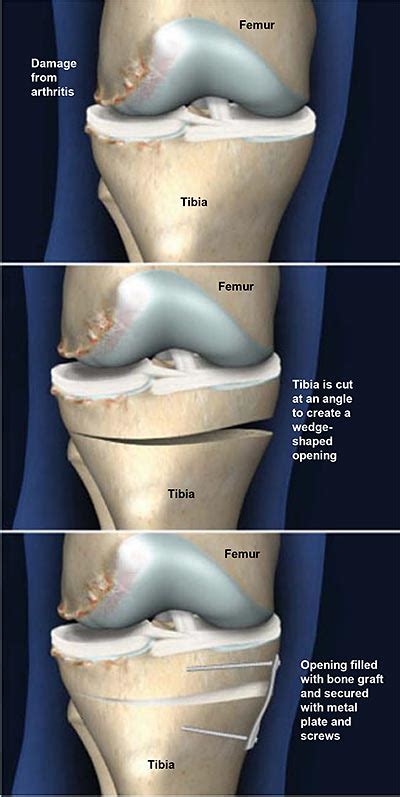 Tibial Osteotomy With Open Wedge Central Coast Orthopedic Medical Group