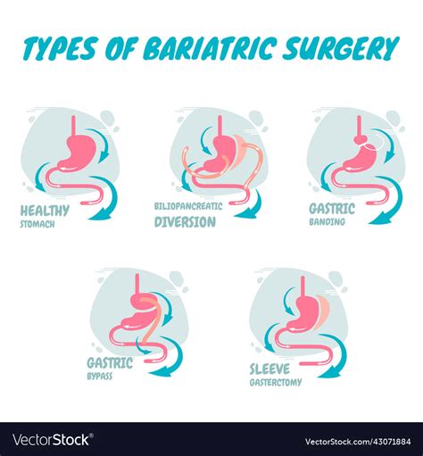 Types Of Bariatric Surgery It Is Process Vector Image