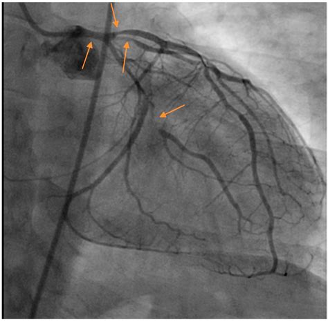 Jcm Free Full Text Update In Spontaneous Coronary Artery Dissection