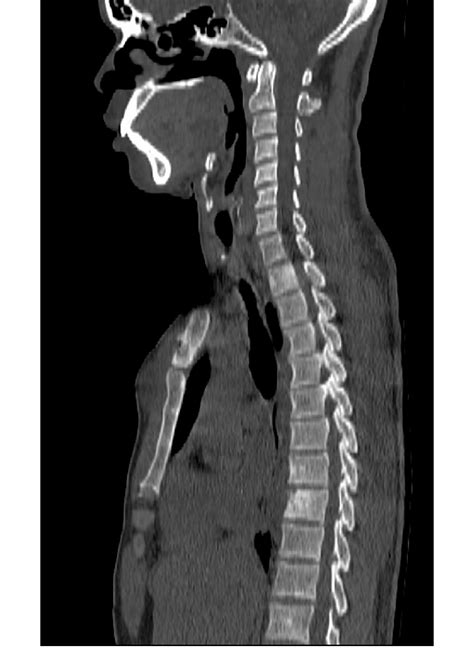 Computed Tomography Scan Of The Neck And Chest Showing The Presternal