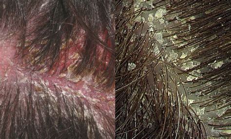 Health Home Remedies For Oily Scalp Dry Scalp And Severe Dandruff