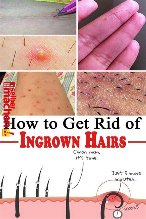 Skin Care Advice That Can Really Help You Ingrown Hair Treat Ingrown Hair