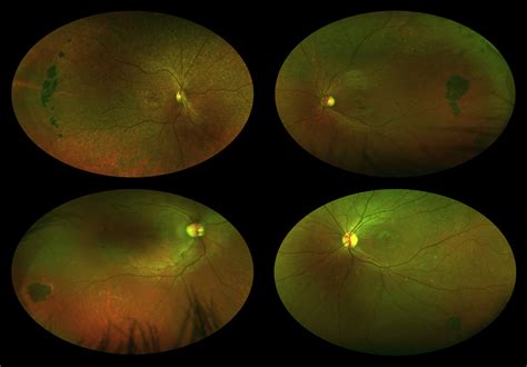 Peripheral Pigmented Retinal Lesions In Stargardt Disease American