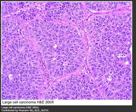 Squamous Cell Carcinoma Lung Histology